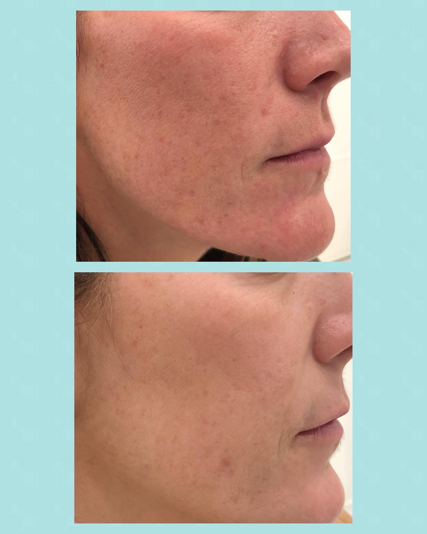 Rosácea - Casos clínicos